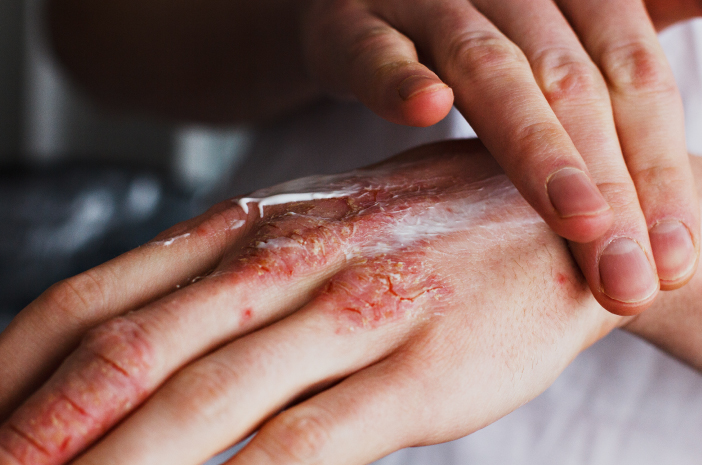 피부 질환을 치료하는 습진 연고의 종류