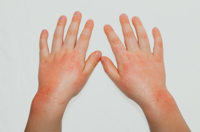 Cunoașteți cauzele alergiilor la copii