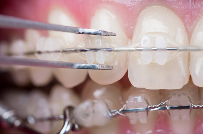세라믹 교정기 사용자를 위한 올바른 치과 치료