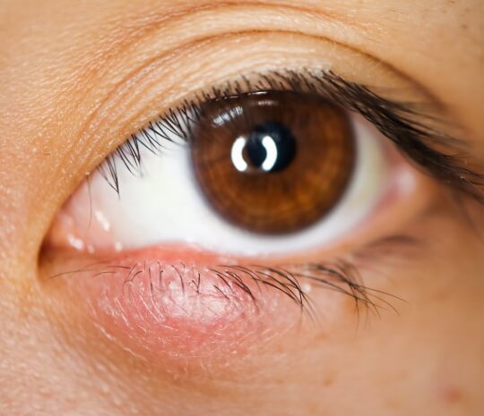 다래끼가 눈 접촉을 통해 전염된다는 것이 사실입니까?