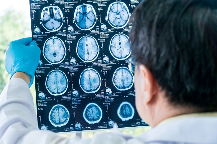 MRI로 알기 쉬운 5가지 질병