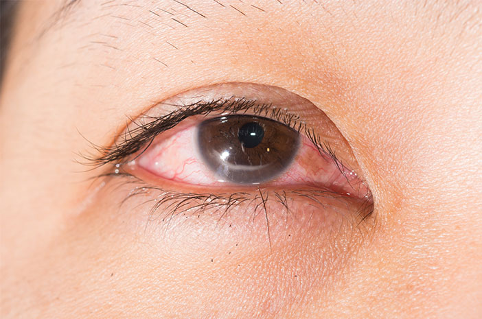각막염에 걸리면 눈에 어떤 일이 발생합니까?