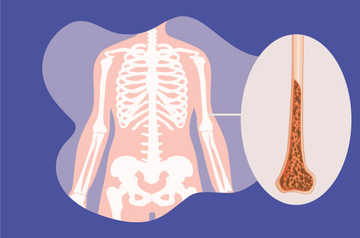 Istnieje wiele rodzajów, poznaj te 4 rodzaje osteoporozy